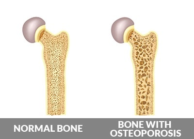 Osteoporosis bone