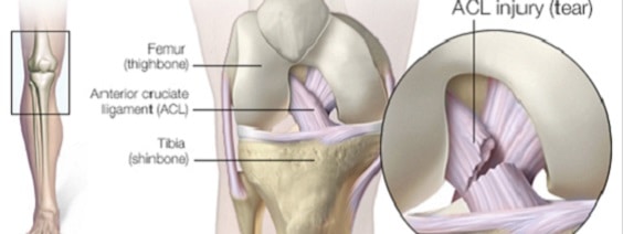 I’ve torn my ACL! Do I need surgery?